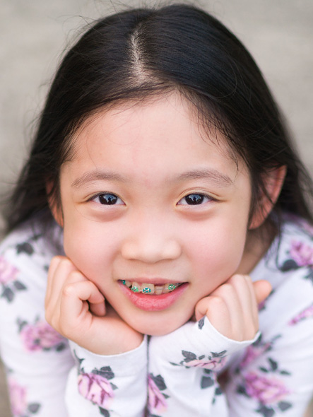 early orthodontic treatment